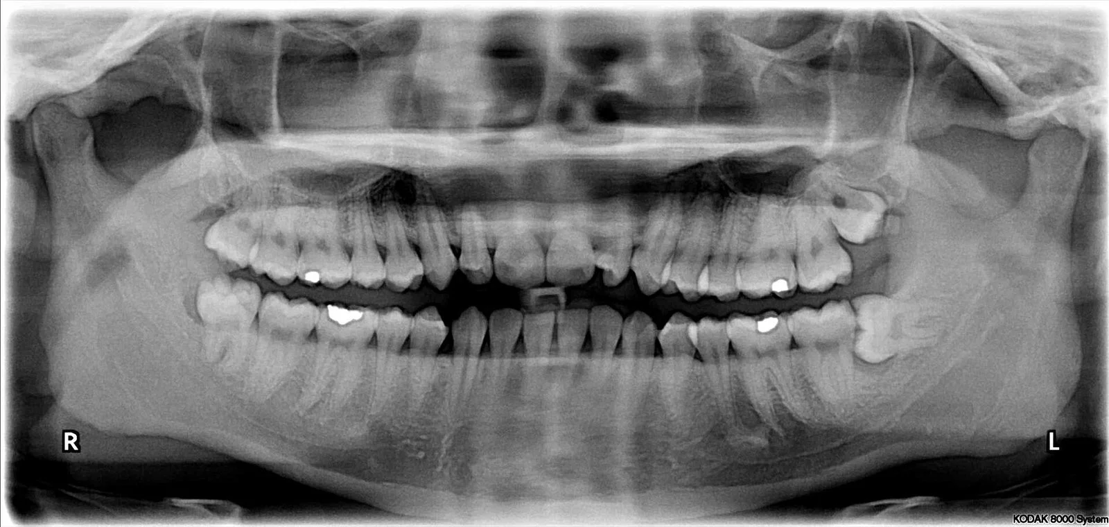 Virginia Blatz Lawsuit 2026 — Family Sues Morden Dentist Over Wisdom-Tooth Death 3 Panoramic dental X-ray showing impacted wisdom teeth, the type of procedure at the centre of the Virginia Blatz Lawsuit